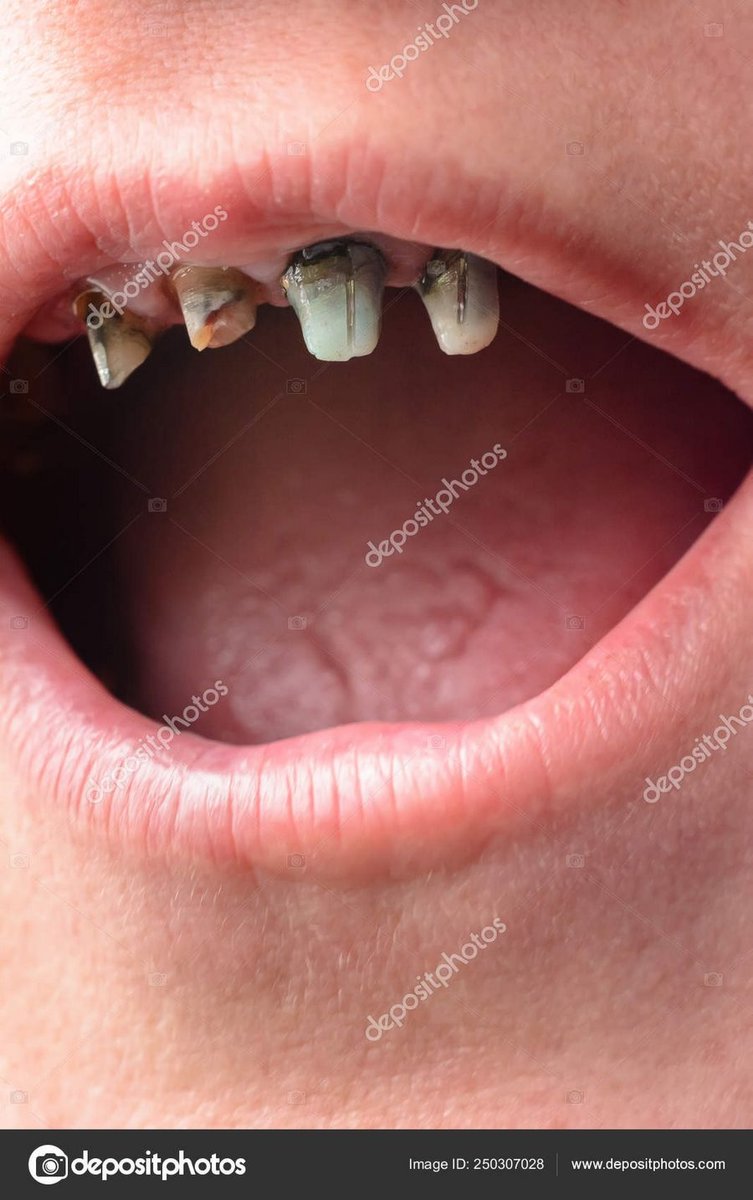 К чему снится гнилой зуб - Сон гнилые зубы