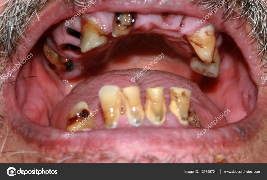 К чему снятся гнилые зубы? Приснился гнилой зуб