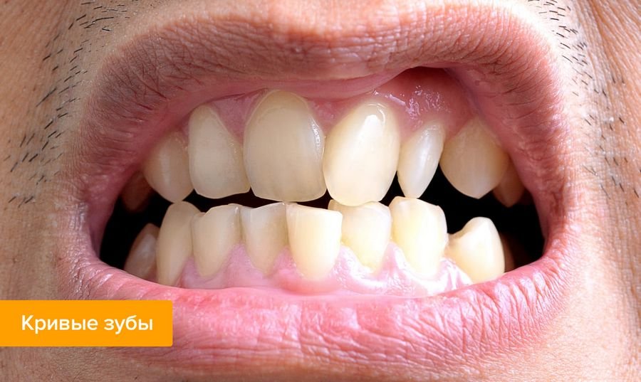 К чему снятся кривые зубы: Сонник нижние зубы