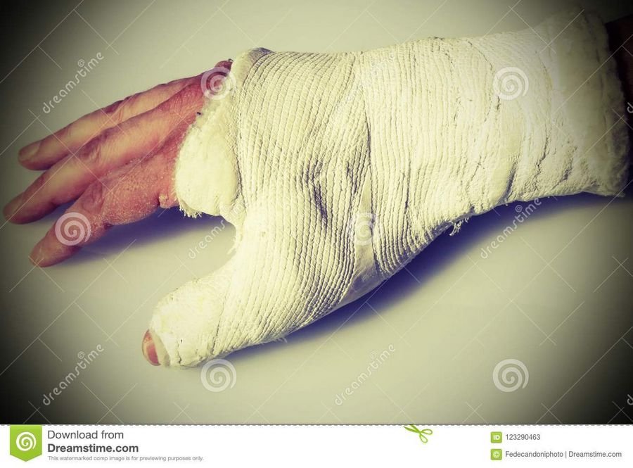 Сонник Сломанные руки - К чему снится сломанная рука