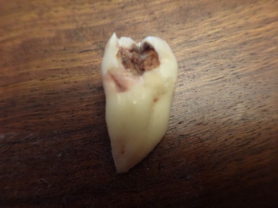 Сонник Вырванные зубы: Приснилось что вырвали зуб